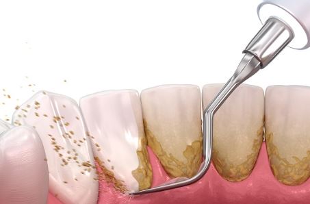 teeth-cleaning-astoria